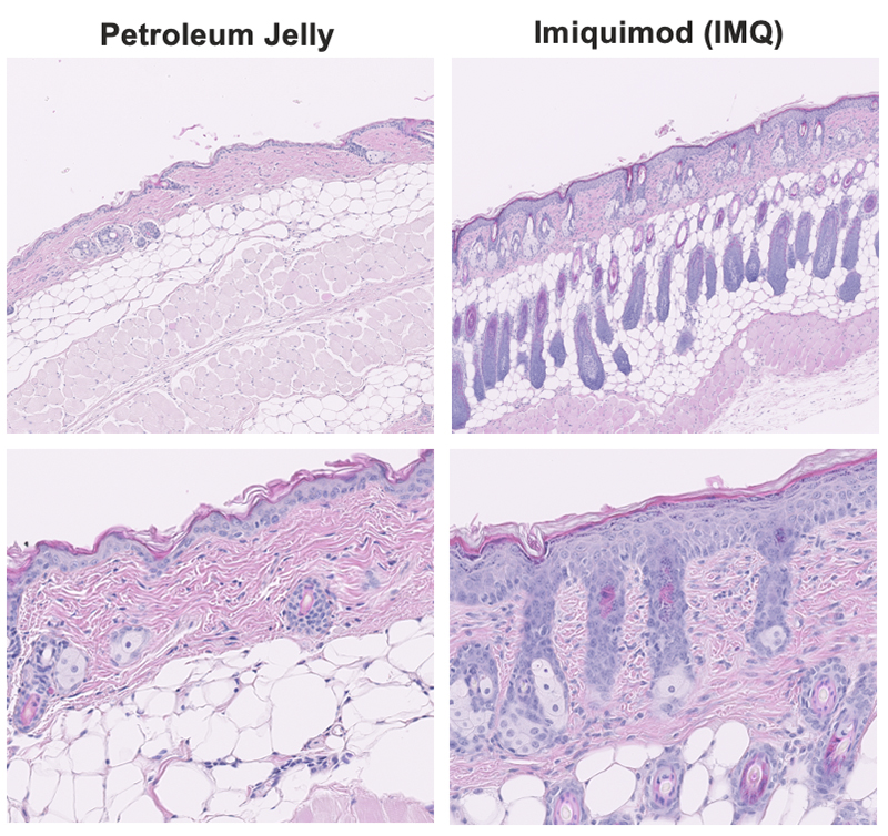 Examples of Imiquimod